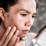 Melasma: What are the best treatments?